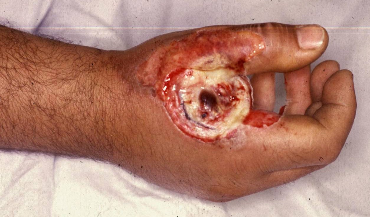 Electric injury Electric shock