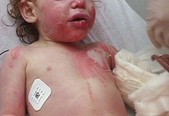 Child with burns from a scald. Hot soup was spill.