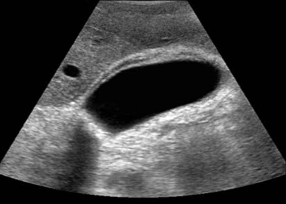 gallbladder ultrasound pics. gallbladder cholecystitis