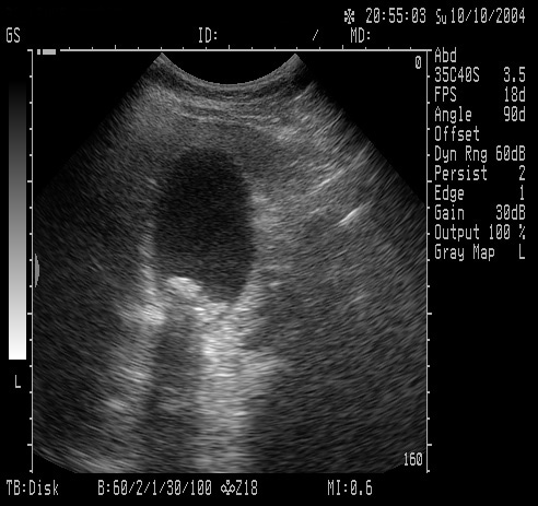 The ultrasound only shows gallstones within the g.