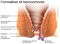Anatomy of external hemorrhoid. Image courtesy of...