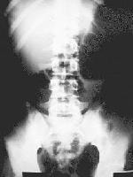Kidneys-ureters-bladder (KUB) radiograph shows an 