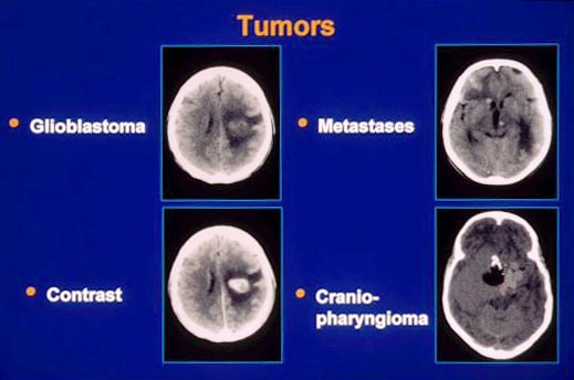 Neoplasms, brain. CT images of several tumor type...