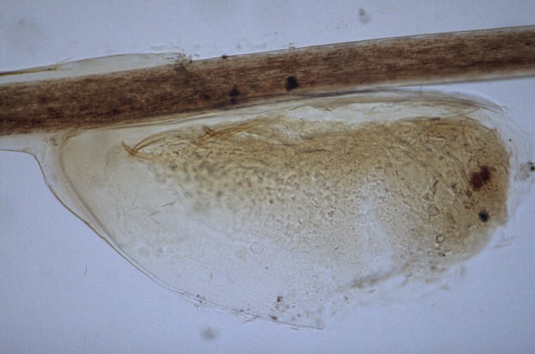 pediculosis. pediculosis capitis images