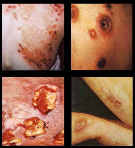 Syphilis. These photographs show close-up images ...