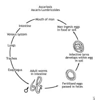 ascaris bowel