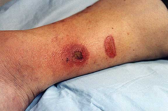 pictures of 2nd degree burns