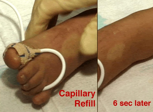 Delayed capillary refill may be the first sign of...