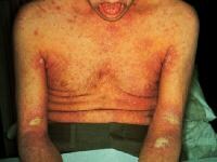 stages of scabies