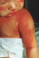 Staphylococcal scalded skin syndrome. Photograph b