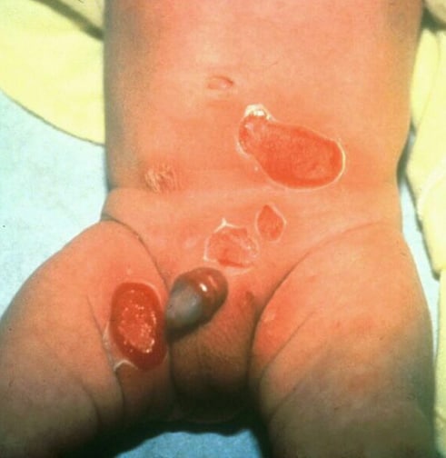 Staphylococcal scalded skin syndrome. Photograph .