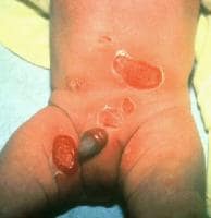 Staphylococcal scalded skin syndrome. Photograph b