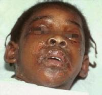 Staphylococcal scalded skin syndrome. Photograph b