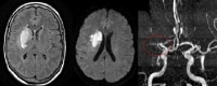 Magnetic resonance imaging (MRI) scan in a 70-year