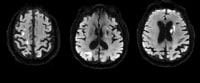 Cardioembolic stroke: Axial diffusion-weighted ima