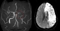 Magnetic resonance angiogram (MRA) in a 52-year-ol