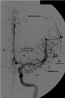 Frontal view of a cerebral angiogram with selectiv
