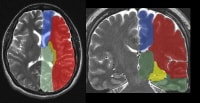 The supratentorial vascular territories of the maj