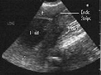 pregnancy emergency medicine workup loss early fluid