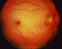 Retinal Artery Occlusion