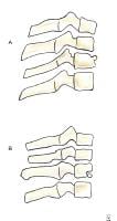 (A) Simple wedge fracture with a flexion mechanis...