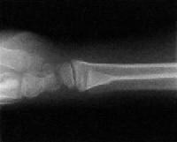 distal radius torus fracture treatment distal radius torus fracture treatment