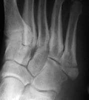 Pseudo Jones Fracture