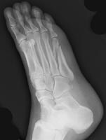 Broken 1St Metatarsal