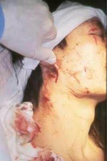 Neck trauma. Zone III injury.