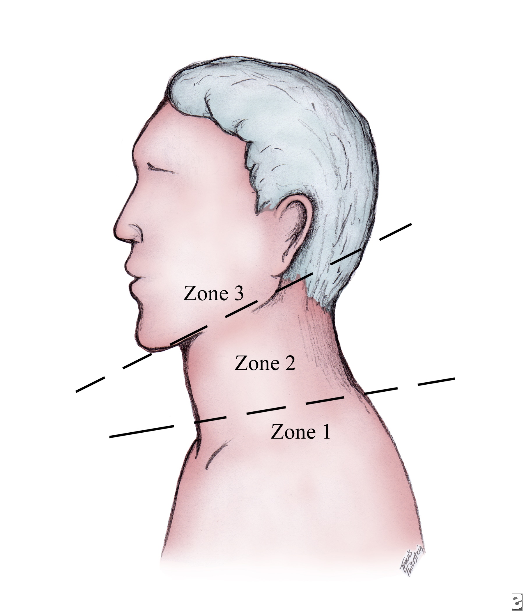 Neck trauma. Zones of the neck.