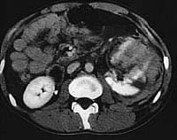 ruptured  kidney