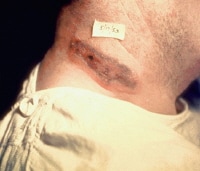 Anthrax infection. Cutaneous anthrax showing the ...