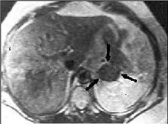 Conn Syndrome