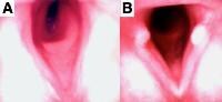 Subtotal Thyroidectomy