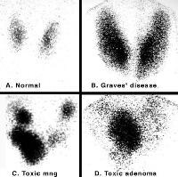 Iodine 123 (123I) nuclear scintigraphy: 123I scans