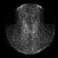 Absence of iodine 123 (123I) radioactive iodine up