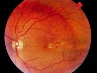 Retinal Exudates