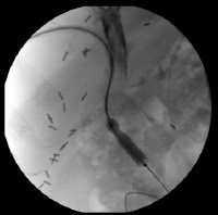 Percutaneous transhepatic cholangiogram with ballo