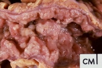 Gross pathology specimen from a case of pseudomemb