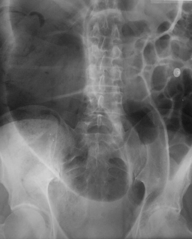 ogilvie syndrome
