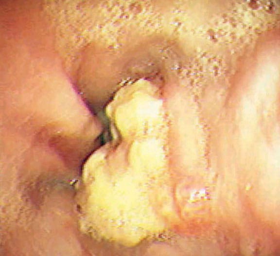 Endoscopy demonstrating intraluminal esophageal c...