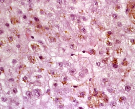 life expectancy of stage 2 sorosis of the liver