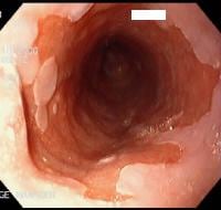 gastric cancer quality of life