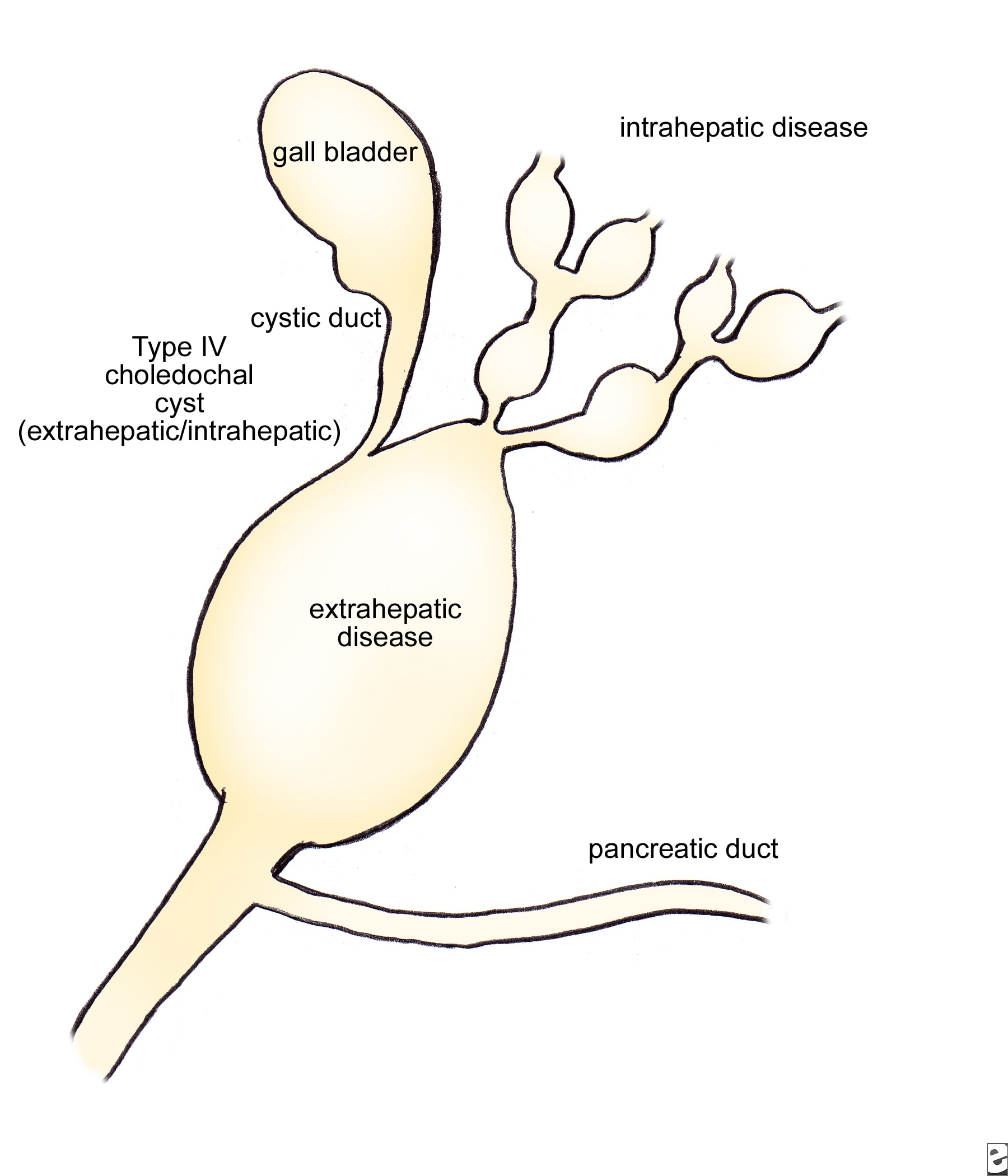 choledochal cyst types