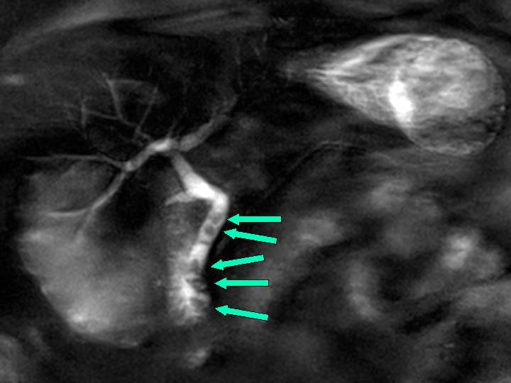 Percutaneous Transhepatic Cholangiography. (percutaneous transhepatic