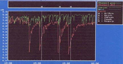 Ambulatory pH monitoring indicating episodes of r...