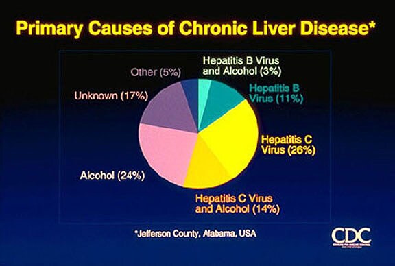 Hepatitis C. Causes of chronic liver disease. Cou...