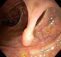 Mucosal Polyp