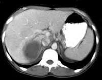 CT scan bụng với IV và độ tương phản uống I