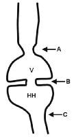 A Ring Esophagus